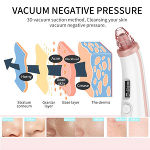 Blackhead Remover Vacuum Pore, Acne, and Pimple Remover. Nose and Face Deep Cleansing Machine. total facial cleanser